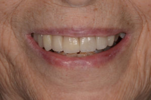 Cosmetic Dental and Implants After