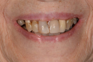 Cosmetic Dental and Implants Before